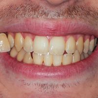 Teeth Whitening - Smile 2 before